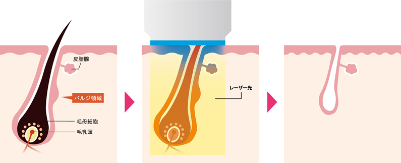 医療脱毛|医療レーザー脱毛のメカニズム