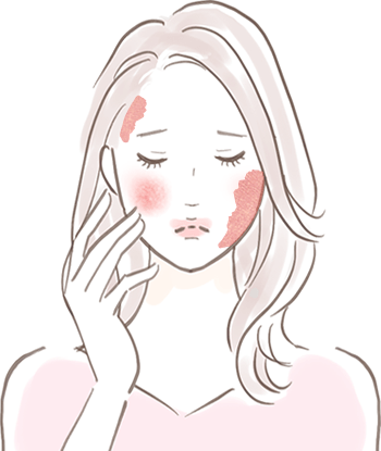 赤ら顔・赤あざ｜美容皮膚科